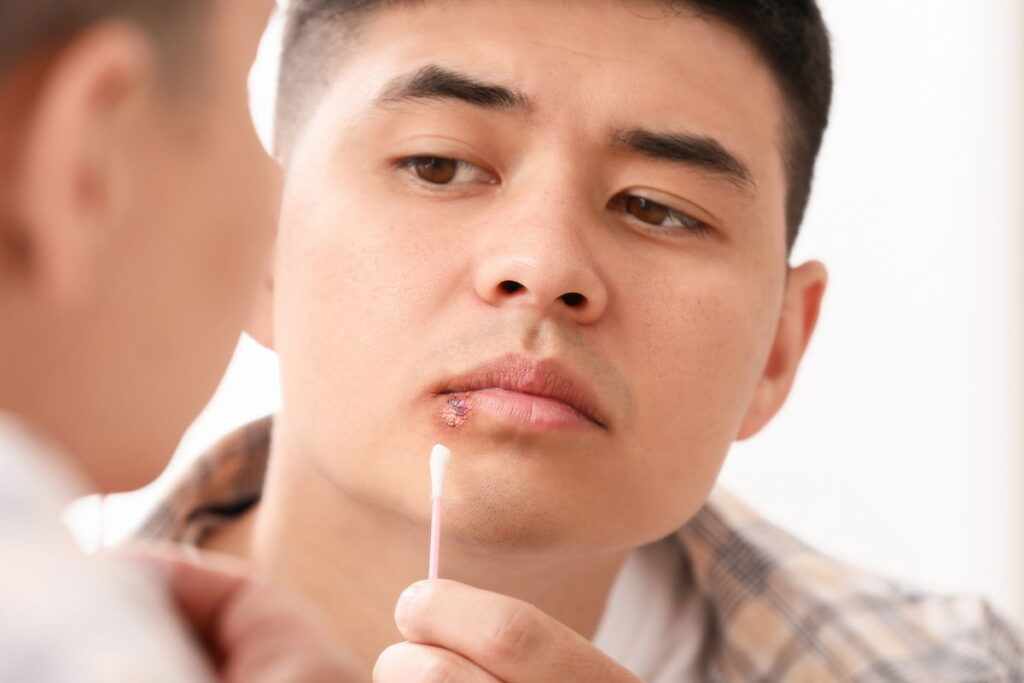 6 sintomas da herpes labial (e o que fazer)
