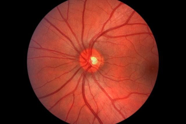 Retinopatia hipertensiva: o que é, sintomas e tratamento