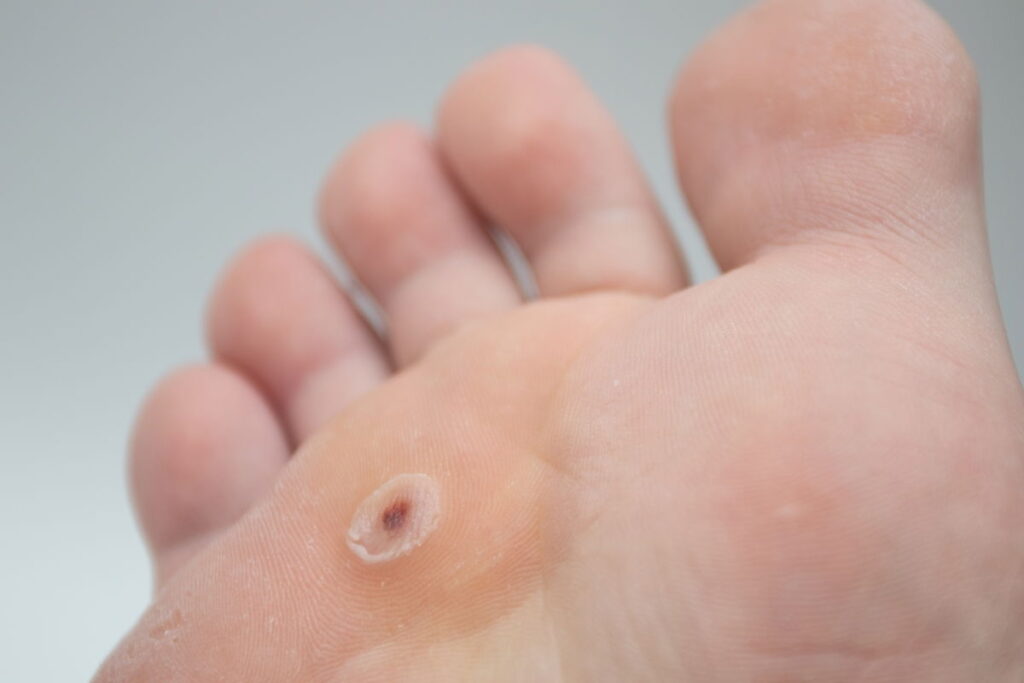 Verruga plantar: o que é, sintomas, causas e tratamento