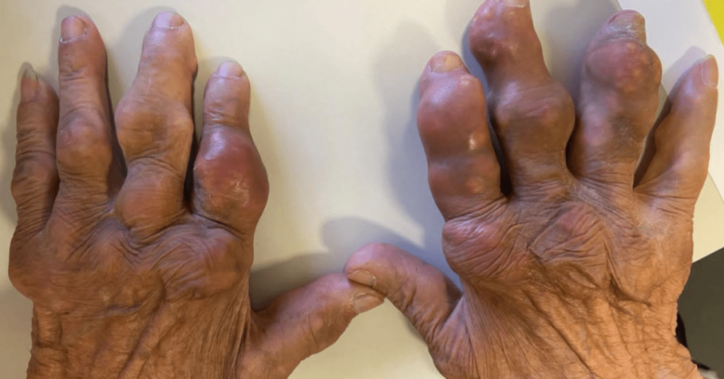 Gota: a “doença dos reis” que hoje ameaça a população em geral