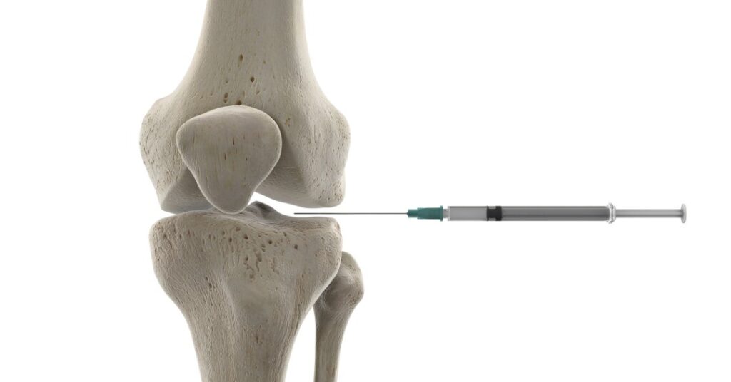 Infiltração no joelho: o que é, quais os benefícios e para quem é indicada
