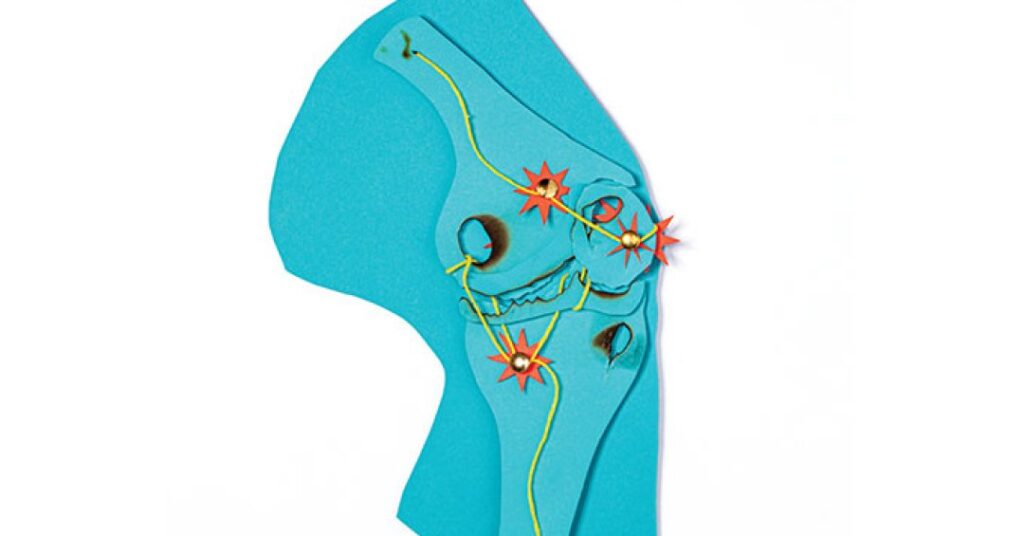 Não é só remédio: 3 novas recomendações dos médicos para cuidar da artrose