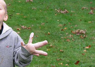 Síndrome de Proteus: o que é, sintomas, causas e tratamento