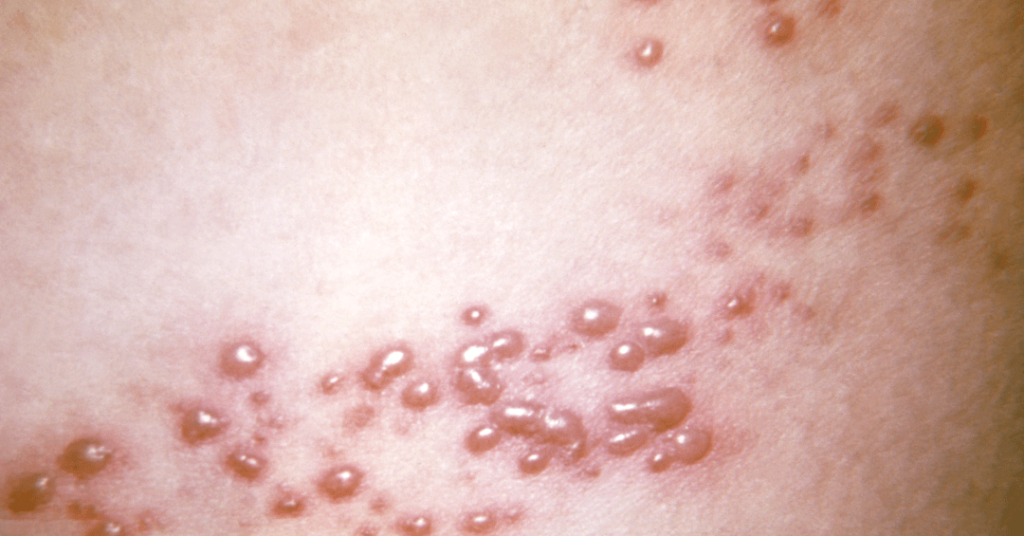 1 em cada 3 pessoas terá herpes-zóster ao longo da vida, saiba como evitar