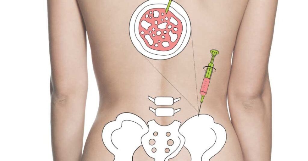 Medula óssea: o que é necessário para se tornar doador no Brasil