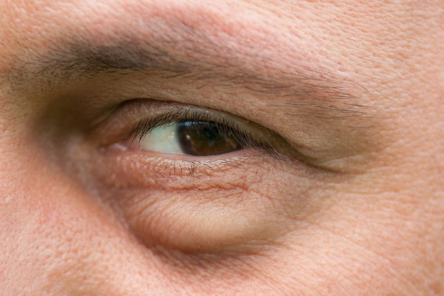 Olhos inchados: 8 causas comuns (e o que fazer)