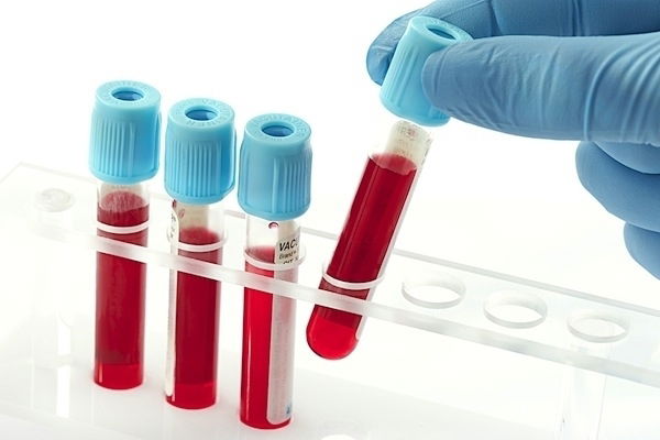 PSA: para que serve o exame, resultados (e o que é PSA total e livre)