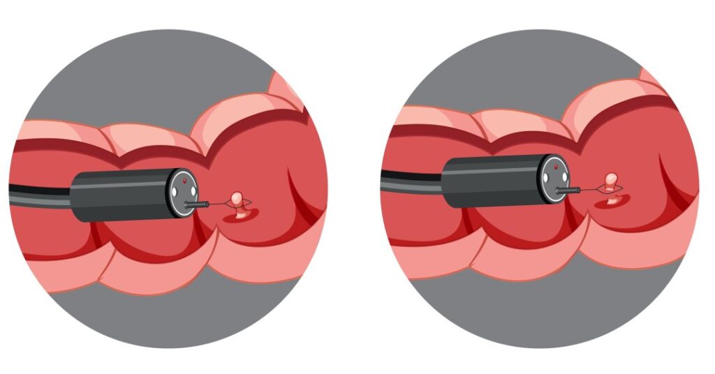 Pólipos intestinais: o que são, quais os sintomas e por que retirá-los