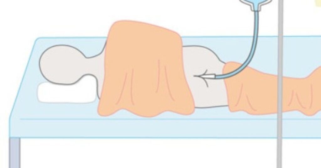 “Respiração anal”: entenda técnica que está em estudos para uso em casos graves