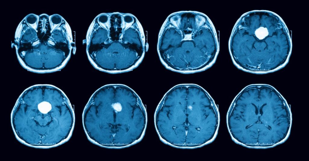 Tumores da hipófise: sintomas, diagnóstico e tratamento