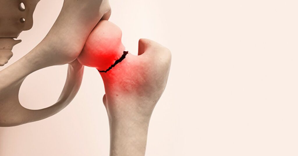 Fratura no quadril: tratamento rápido evita complicações e preserva a mobilidade do idoso