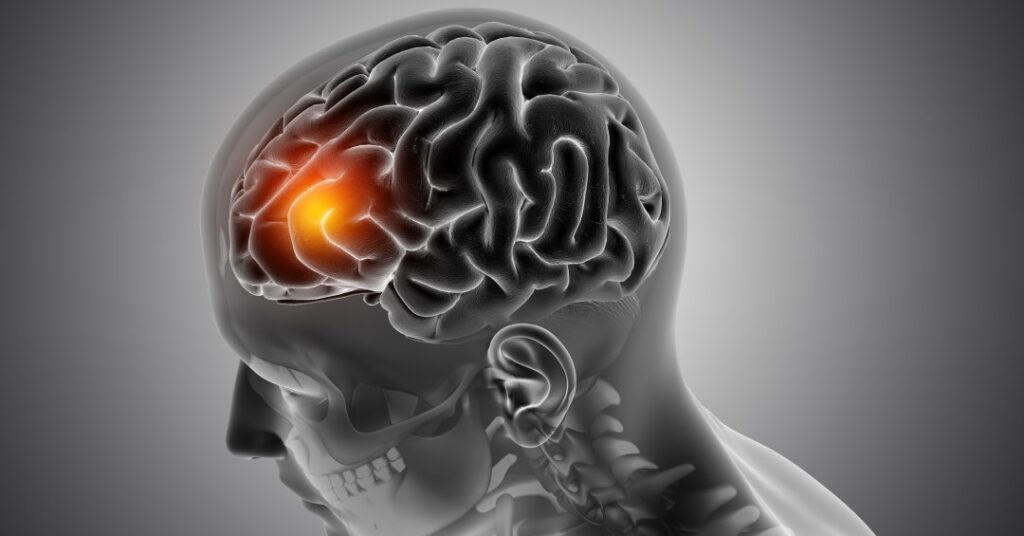 Trombose cerebral: o que é, quais os sintomas e tratamentos