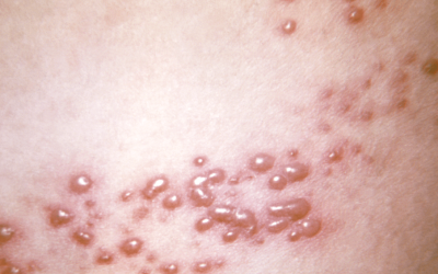 1 em cada 3 pessoas terá herpes-zóster ao longo da vida, saiba como evitar