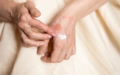 Alergia nas mãos: sintomas, causas e tratamento