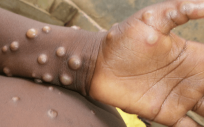 Brasil registra 2º caso de cepa mais letal do Mpox; saiba as chances de surto no país