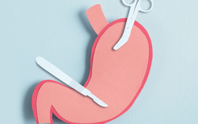 CFM amplia indicação da cirurgia bariátrica;...
