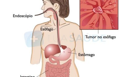 Câncer de esôfago: o que é, sintomas, causas e tratamento