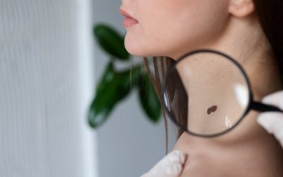 Câncer de pele: dermatologistas oferecerão atendimento gratuito em todo o Brasil