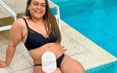 Colostomia definitiva: saiba quando é indica...