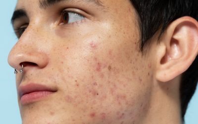 Como tirar manchas de espinhas? Aprenda a re...