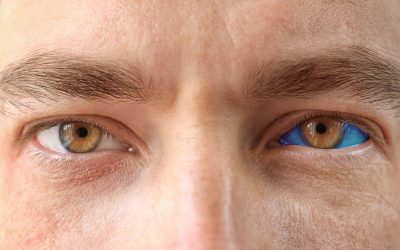 Esclera azul: o que é, sintomas, causas e o que fazer