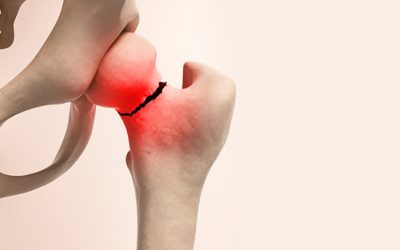 Fratura no quadril: tratamento rápido evita complicações e preserva a mobilidade do idoso