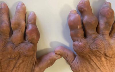 Gota: a “doença dos reis” que hoje ameaça a população em geral