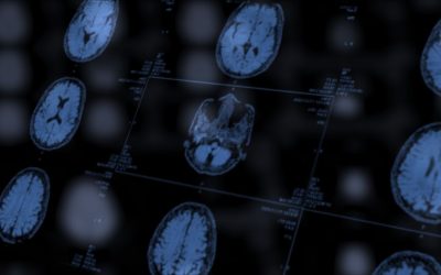 IA detecta anormalidades cerebrais invisíveis em pessoas com epilepsia