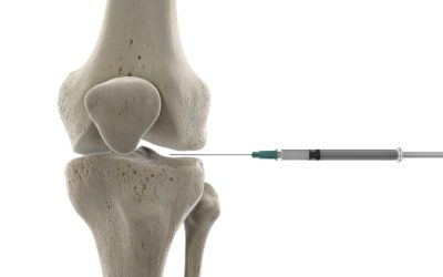 Infiltração no joelho: o que é, quais os benefícios e para quem é indicada