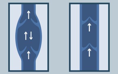 Insuficiência venosa crônica: o que é, sintomas e tratamento