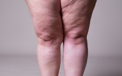 Lipedema: como a alimentação pode ajudar no...