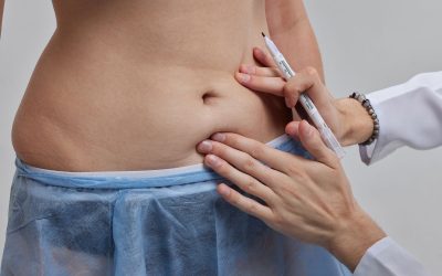 Lipoenxertia: o que é, para que serve, como é feita e recuperação