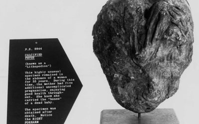 Litopedia: quando ocorre a calcificação do feto?