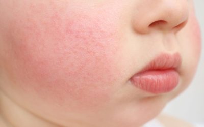 Manchas vermelhas no bebê: o que pode ser (e como tratar)