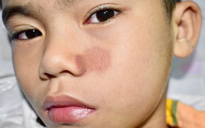 Micose de pele: sintomas, 8 tipos e como tratar (com fotos)