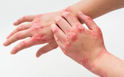 Mounjaro pode mudar o tratamento da artrite psoriática, aponta novo estudo