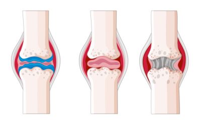 Osteoartrite: o que é, como surge e o que fazer diante da artrose