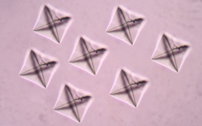 Oxalato de cálcio na urina: o que pode ser (e o que fazer)