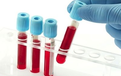 PSA: para que serve o exame, resultados (e o que é PSA total e livre)