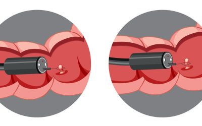 Pólipos intestinais: o que são, quais os sintomas e por que retirá-los