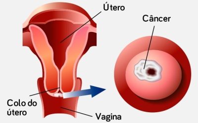 Principais causas de câncer de colo de útero (e como prevenir)