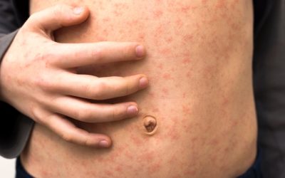 Sarampo: mortes nos EUA reforçam importância da vacina