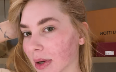 Virgínia faz procedimento para aumentar colágeno no rosto e tem efeitos colaterais