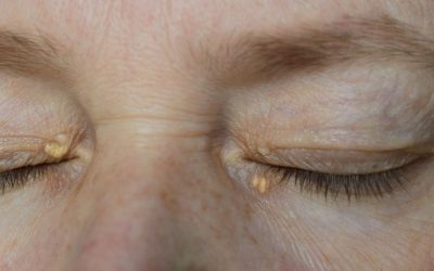 Xantelasma: o que é, características, causas e tratamento